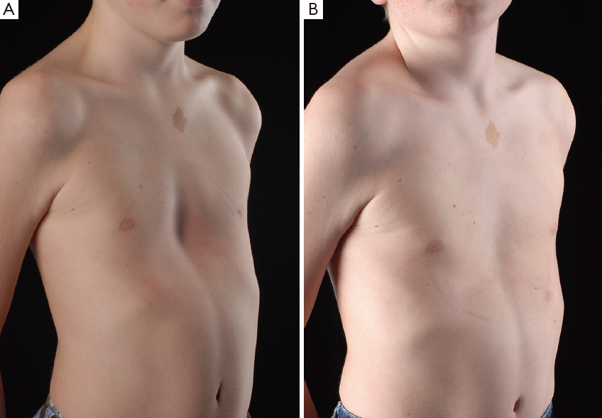 Vacuum Bell for Pectus Excavatum
