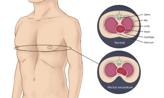 What to know about Funnel Chest (Pectus Excavatum)